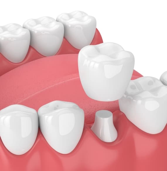 Dental Crowns - Wodonga Family Dental Clinic