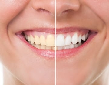 Teeth Whitening Cosmetic Dentistry - Wodonga Family Dental Clinic