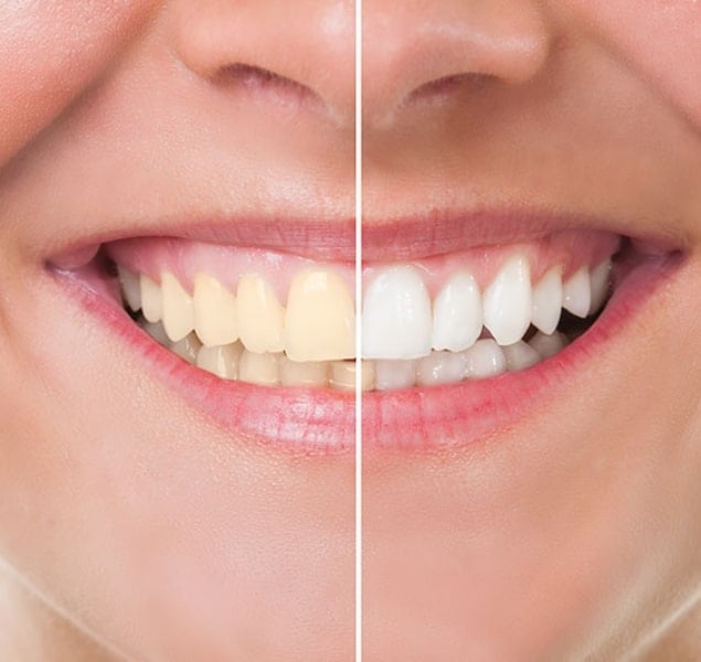 At Home Teeth Whitening - Wodonga Family Dental Clinic