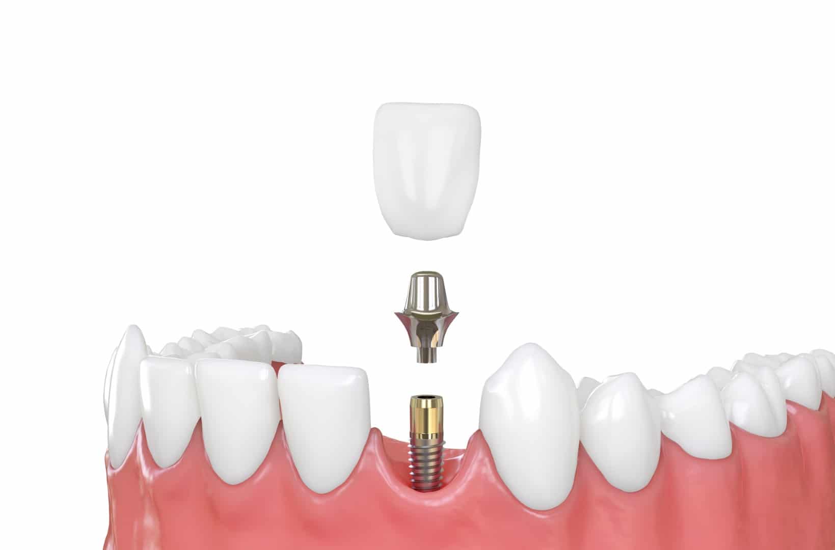 Dental Implants - Dental Care Services - Wodonga Family Dental Clinic