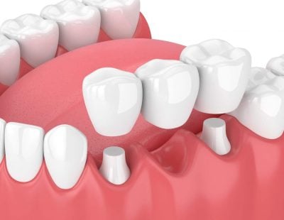 Dental Bridges - Wodonga Family Dental Clinic