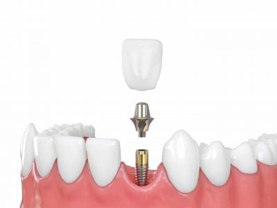 Dental Implants - Dental Care Services - Wodonga Family Dental Clinic