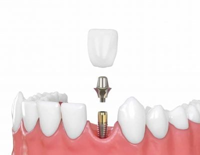 Dental Implants - Dental Care Services - Wodonga Family Dental Clinic